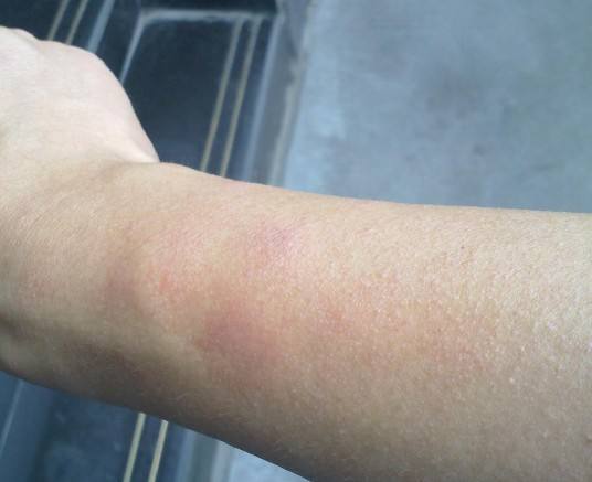 当然,暴露在空气中的皮肤也会受到甲醛的刺激,出现发红,发痒等过敏